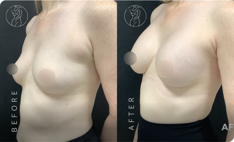 types of breast implants, saline implants, silicone implants, gummy bear implants